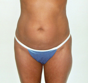 Tummy Tuck