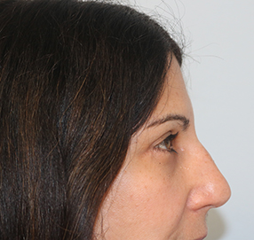 Blepharoplasty