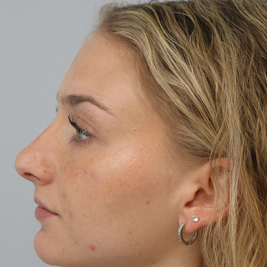 Rhinoplasty