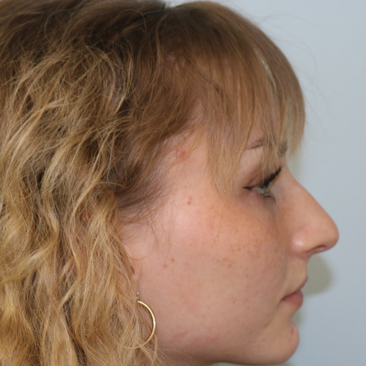 Rhinoplasty