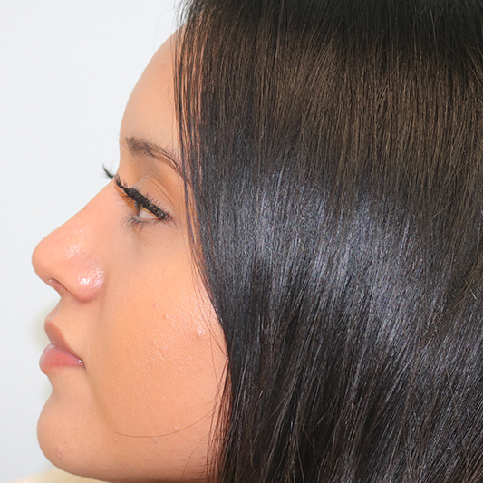 Rhinoplasty