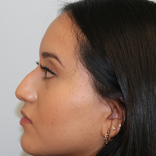 Rhinoplasty