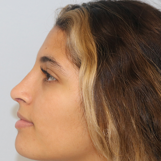 Rhinoplasty