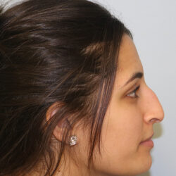 Rhinoplasty