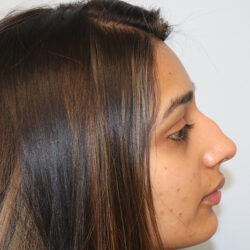 Rhinoplasty