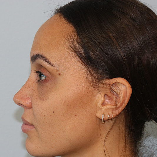 Rhinoplasty