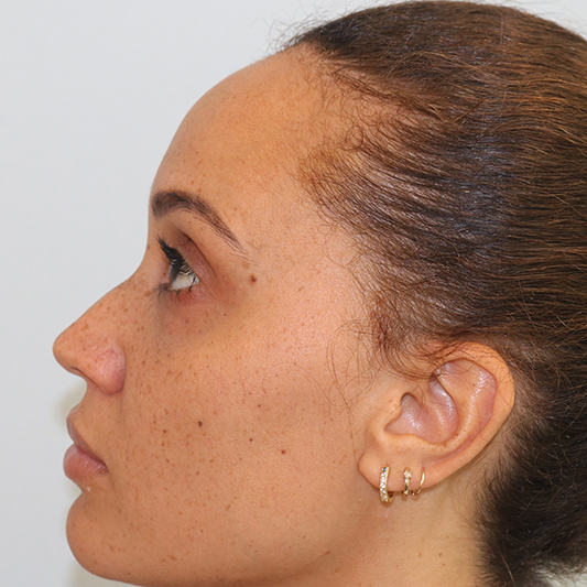 Rhinoplasty