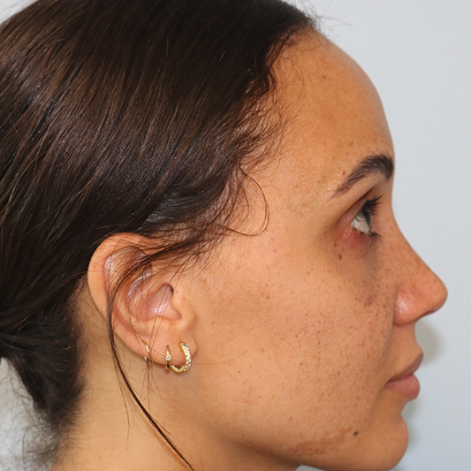 Rhinoplasty