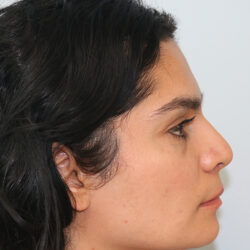 Rhinoplasty